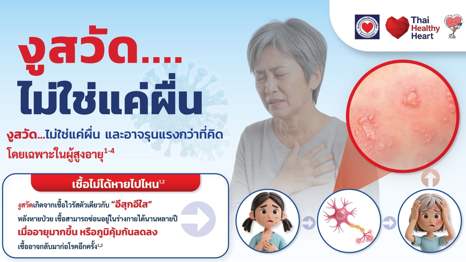 งูสวัด ไม่ใช่แค่ผื่น!